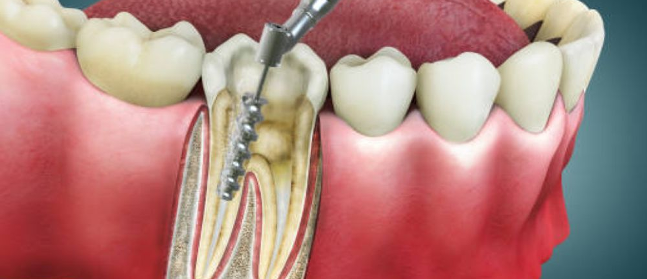 Root Canal Therapy in Al Ain - Happy Smile Dental Clinic